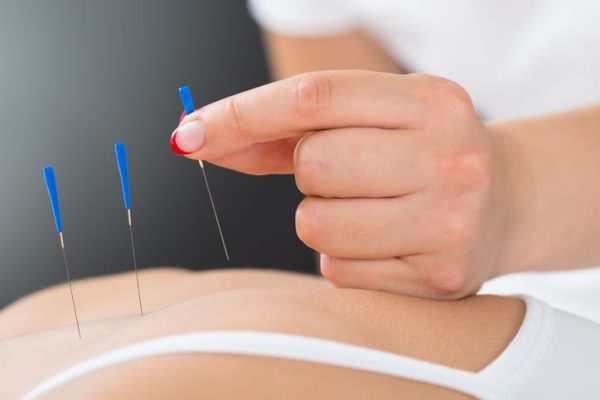 Terapi Akupunktur Medik