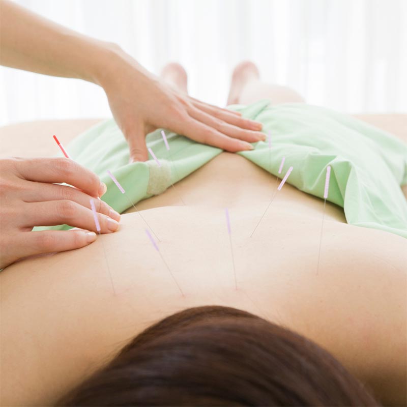 tubuh ideal dengan akupunktur slimming